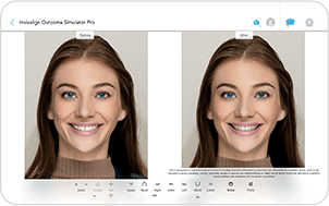 인비절라인(Invisalign) 특징