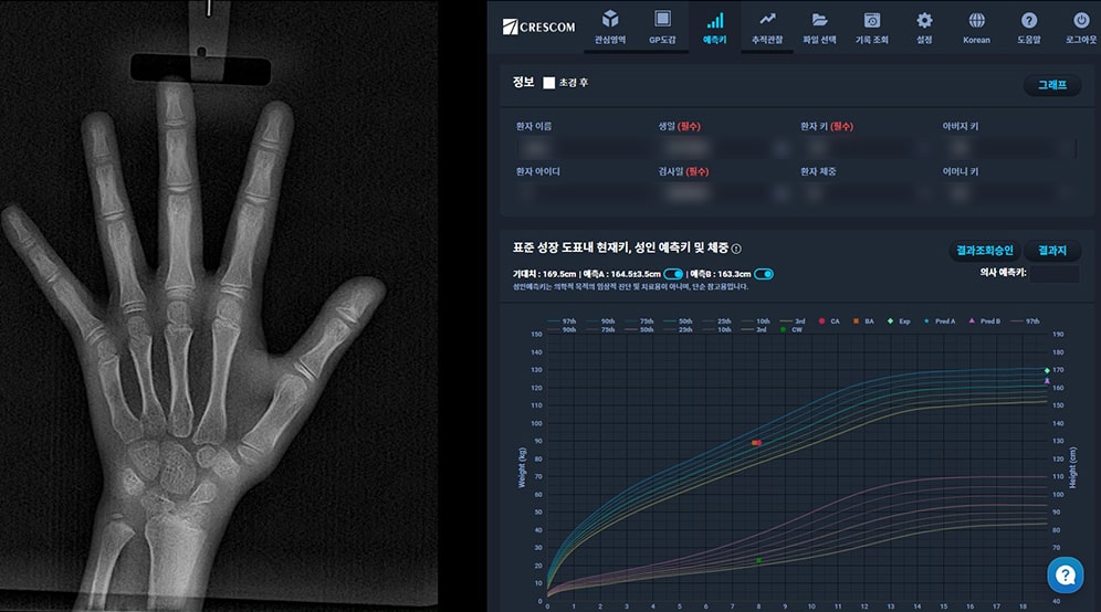 AI 성장 진단 손 뼈 엑스레이 분석