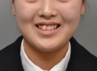 2급 2류 부정교합 · 과개교합 비발치 교정