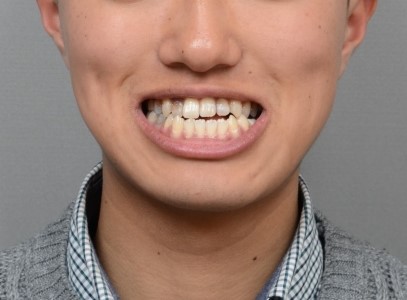수술교정에서 절충교정으로 전환한 골격성 3급 부정교합 증례｜후구치융기 미니스크류와 하악 후방이동