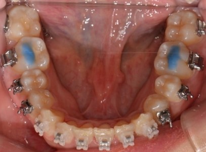 판교교정치과 교정 바이트 블럭(Bite Block) 사용 이유 | 레진 블록 역할·기간·주의사항