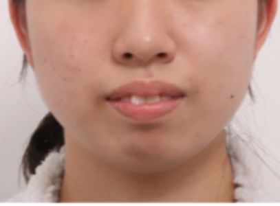 상악 편악 발치교정으로 입술폐쇄부전과 스마일아크 개선한 2급 부정교합 치료 사례