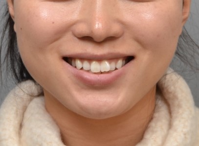 하악 전치 결손이 있는 돌출입, 비대칭 발치로 개선한 교정 증례｜분당교정치과 서울리인치과
