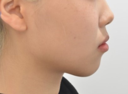돌출입 발치교정으로 인상까지 개선한 20대 여성 증례｜미금역교정치과 서울리인치과