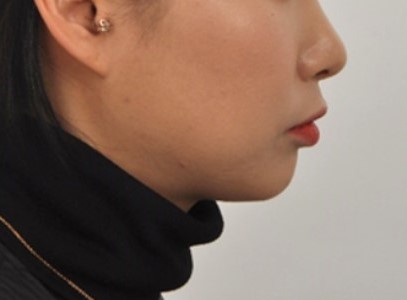 달라진 프로필! 돌출입 교정 치료 사례 I 미금역교정치과