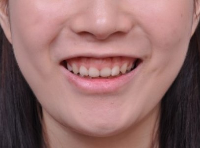 판교치아교정 거미스마일(잇몸 웃음) 비발치 치료 | 서울리인치과교정과의원