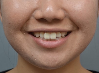 미금역교정치과 / 사랑니만 뽑고도 가능했던 비발치 교정, 자연스러운 입매 완성기