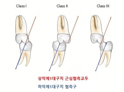 치아교정 필수 지식: 1급·2급·3급 구치 관계 쉽게 이해하기 | 미금역교정치과 서울리인치과교정과