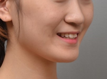 얼굴형을 고려한 발치 선택, 상악 편악 발치 교정 사례