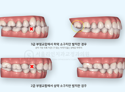 하악 편악 발치를 하지 않는 이유 I 수내역치과