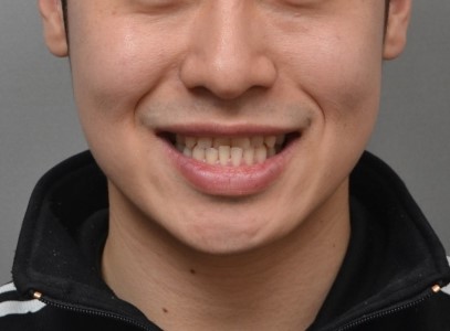 미금역교정치과 앞니 반대교합 부분교정 사례 | 미니스크류·치간삭제로 스마일라인 개선