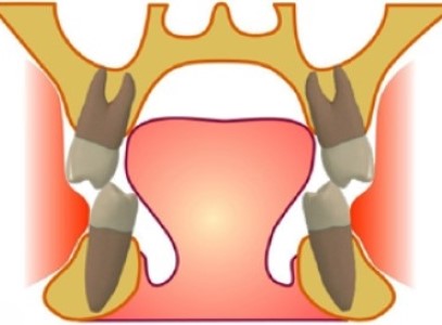 가위교합(Scissors Bite) 치료 – 어금니 부분교정으로 건강한 교합 회복