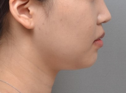 자연스러운 입매를 만든 돌출입 교정 사례｜성남교정치과 서울리인치과  메타디스크립션