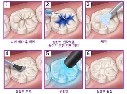 어린이 충치 예방치료 실란트, 꼭 해야 할까? I 미금교정치과