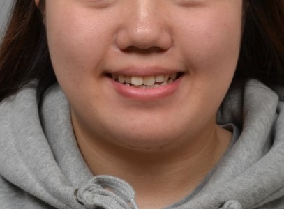수능 직후 시작한 3급 개방교합 교정, 자연스러운 측모까지 개선한 사례｜분당교정치과 서울리인치과