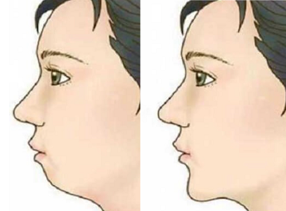 치아교정으로 개선 가능한 무턱(하악후퇴) — 원인, 진단, 치료방법 안내