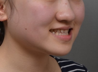골격성 3급 단안모 여학생, 하악 후방이동과 전치 정출로 측모 개선한 교정 증례｜분당판교 교정치과