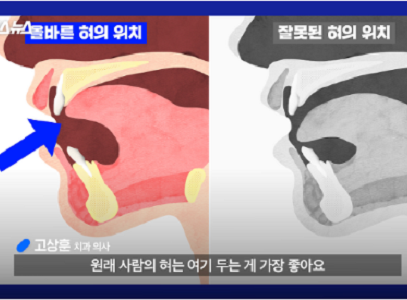 분당 판교 교정치과 | 혀 위치 교정과 근기능요법(MFT)으로 교정 치료 안정화하는 방법