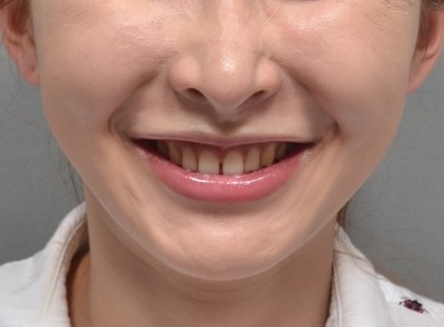 치간이개(벌어진 치아) 교정, 모두 닫지 않는 이유도 있습니다｜분당판교 교정치과 서울리인치과