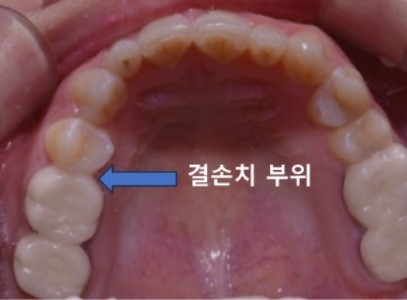 결손치 임플란트 없이 교정치료로 해결! – 분당·판교 교정 전문치과 사례