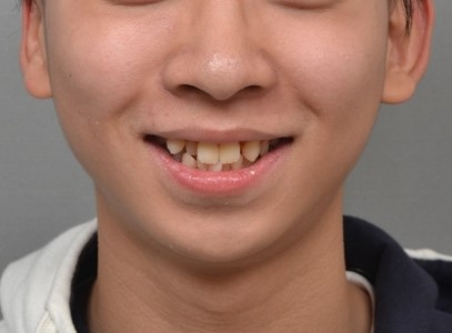 분당판교 교정치과 | 덧니·측절치 반대교합·2급 부정교합 발치 교정 실제 사례
