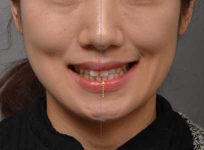 상·하악 중심선 비대칭과 2급·3급 구치관계, 비발치 교정으로 1급 교합 회복한 20대 여성 사례