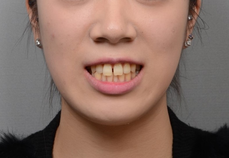 상악 정중이개와 3급 교합, 비발치 후방이동으로 개선한 20대 여성 교정 증례｜분당판교 교정치과 서울리인치과