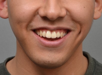 비발치로 개선한 골격성 2급 개방교합 증례｜상악 확장·구치부 압하·하악 후방이동 교정