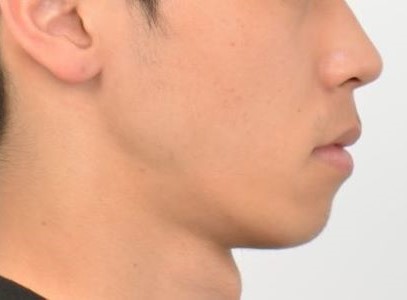 20대 남성 토끼이 교정｜앞니 배열부터 자연스러운 입매 개선까지