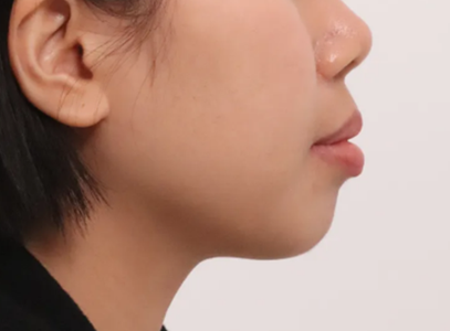 돌출입 원인과 교정 치료 접근 방법
