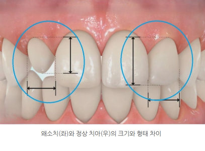 분당 치아교정 | 왜소치가 교합에 미치는 영향과 치료 필요성