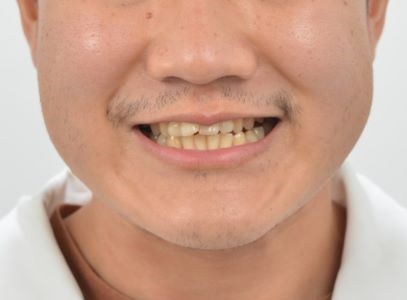 주걱턱 교정, 입이 들어갈까 걱정된다면? 비발치 개방교합 교정 치료 사례