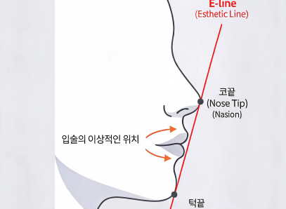 E-line(Esthetic Line)이란? 돌출입과 옆모습 균형을 판단하는 교정 기준 | 분당 서울리인치과