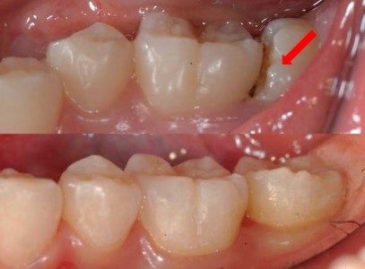 15세 남학생 하악 제2대구치 Mesial Locking 부분교정 증례｜성장기 영구치 맹출 이상 조기 치료