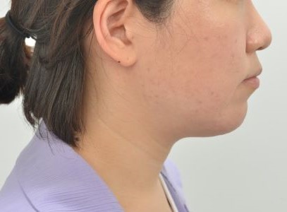 돌출입 비발치교정을 원했지만 발치를 선택한 이유 | 30대 여성 돌출입 교정 증례