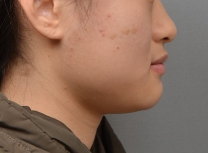 하악 치아 사이 공간, 그냥 닫아도 될까요?｜15세 여학생 공간폐쇄·과개교합 부분교정 증례