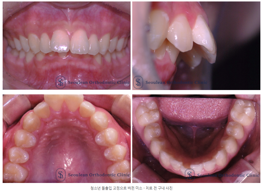 분당 청소년 돌출입 교정 치료 전 치아 배열 상태