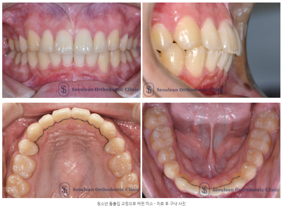 분당 청소년 돌출입 교정 후 가지런해진 치열