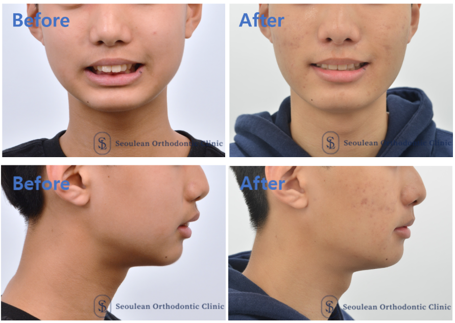 분당 판교 청소년 돌출입 교정 치료 전후 얼굴 비교