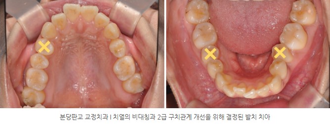 분당판교 교정치과 I 치열의 비대칭과 2급 구치관계 개선을 위해 결정된 발치 치아