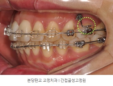 분당판교 교정치과 I 간접골성고정원