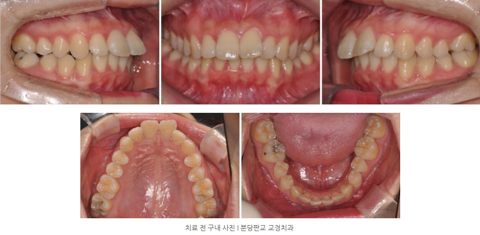 교정치료 전 구내사진 I 분당판교 교정치과 서울리인치과