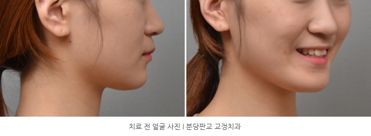 교정치료 전 얼굴 사진I 분당판교 교정치과 서울리인치과