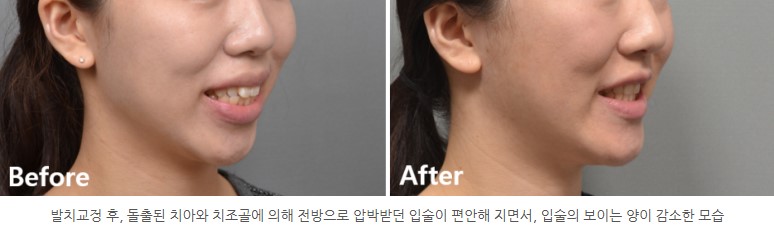 입술폐쇄부전 개선 I 분당판교 교정치과 서울리인치과