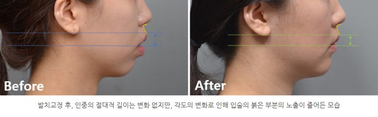 발치교정 전후 인중 길이 변화 I 분당판교 교정치과 서울리인치과