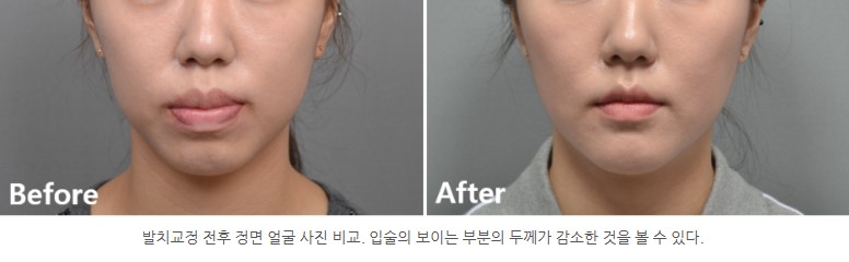 발치교정 전후 입술 두께 변화 I 분당판교 교정치과 서울리인치과