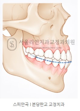 스피만곡이란 I 분당판교 교정치과 서울리인치과