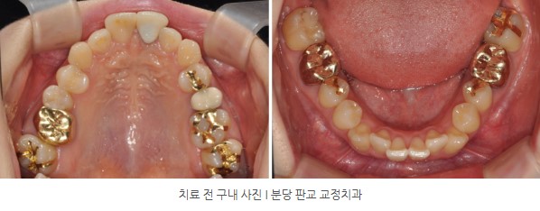 분당판교 교정치과 I 토끼이 교정치료 전 구내사진