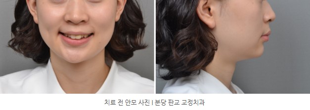 분당판교 교정치과 I 토끼이 교정치료 전 안모사진