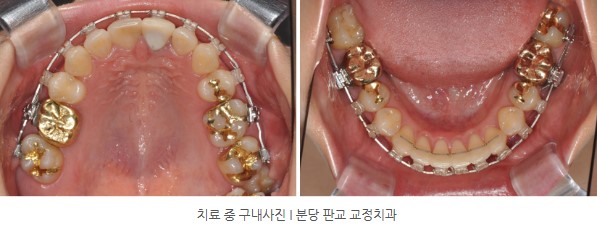 분당판교 교정치과 I 토끼이 교정치료 중 구내사진